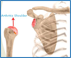 Total Shoulder Joint Arthroplasty Video| Murdoch & Subiaco, Perth WA